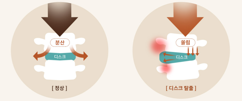 Biomechanical load distribution comparison between a healthy spine and a herniated disc