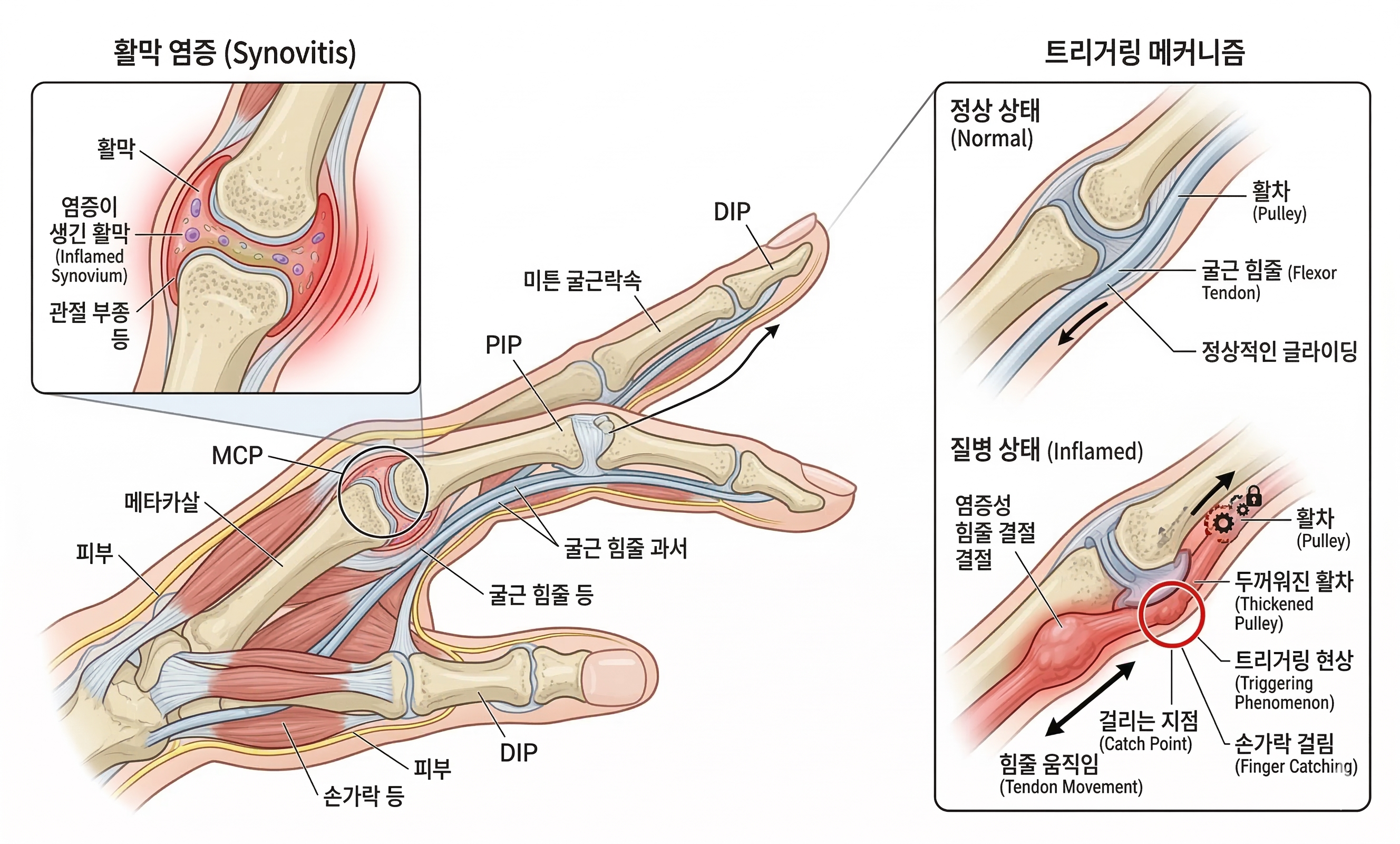 Causes of finger arthritis and tenosynovitis