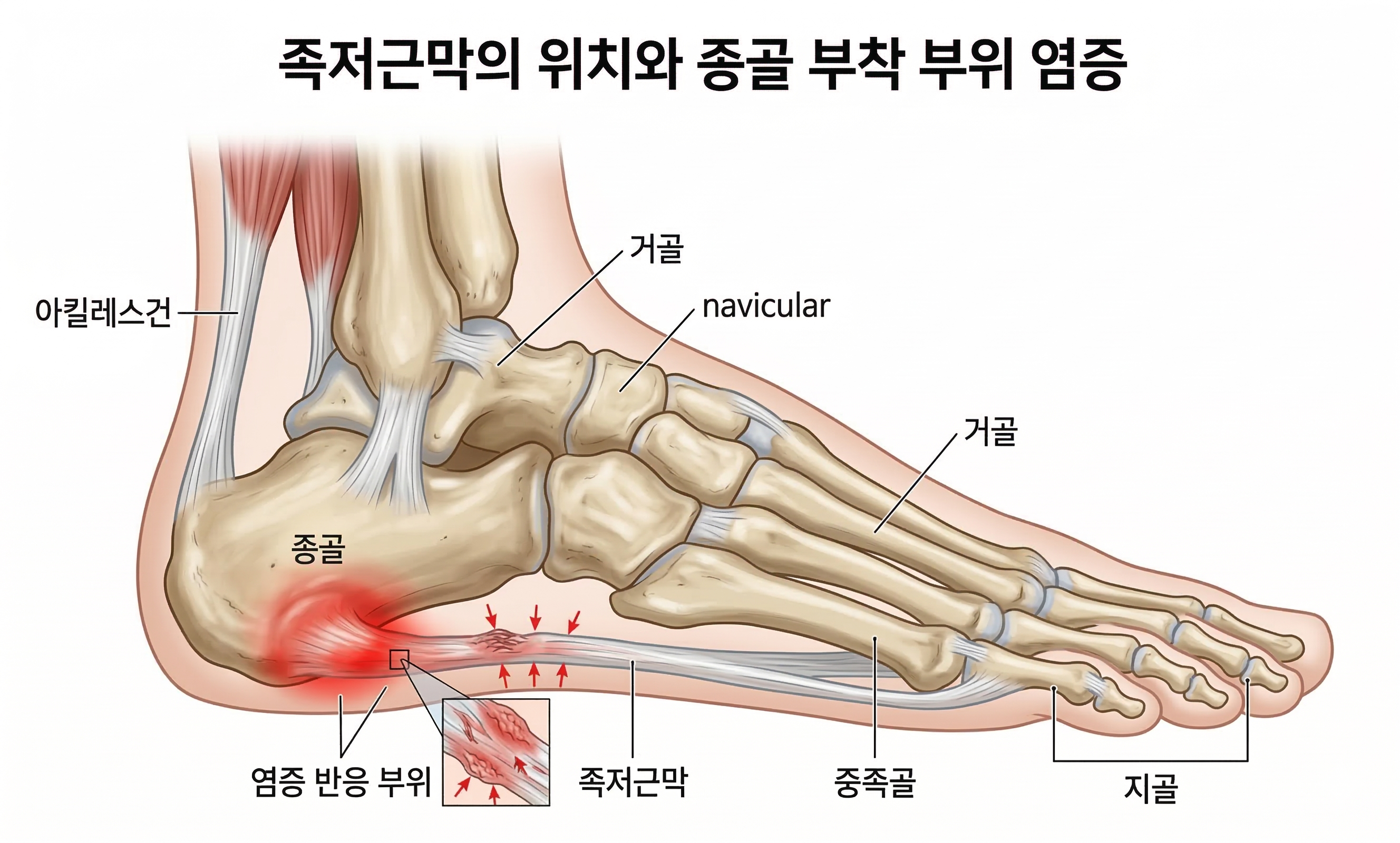 Mechanism and anatomy of plantar fasciitis