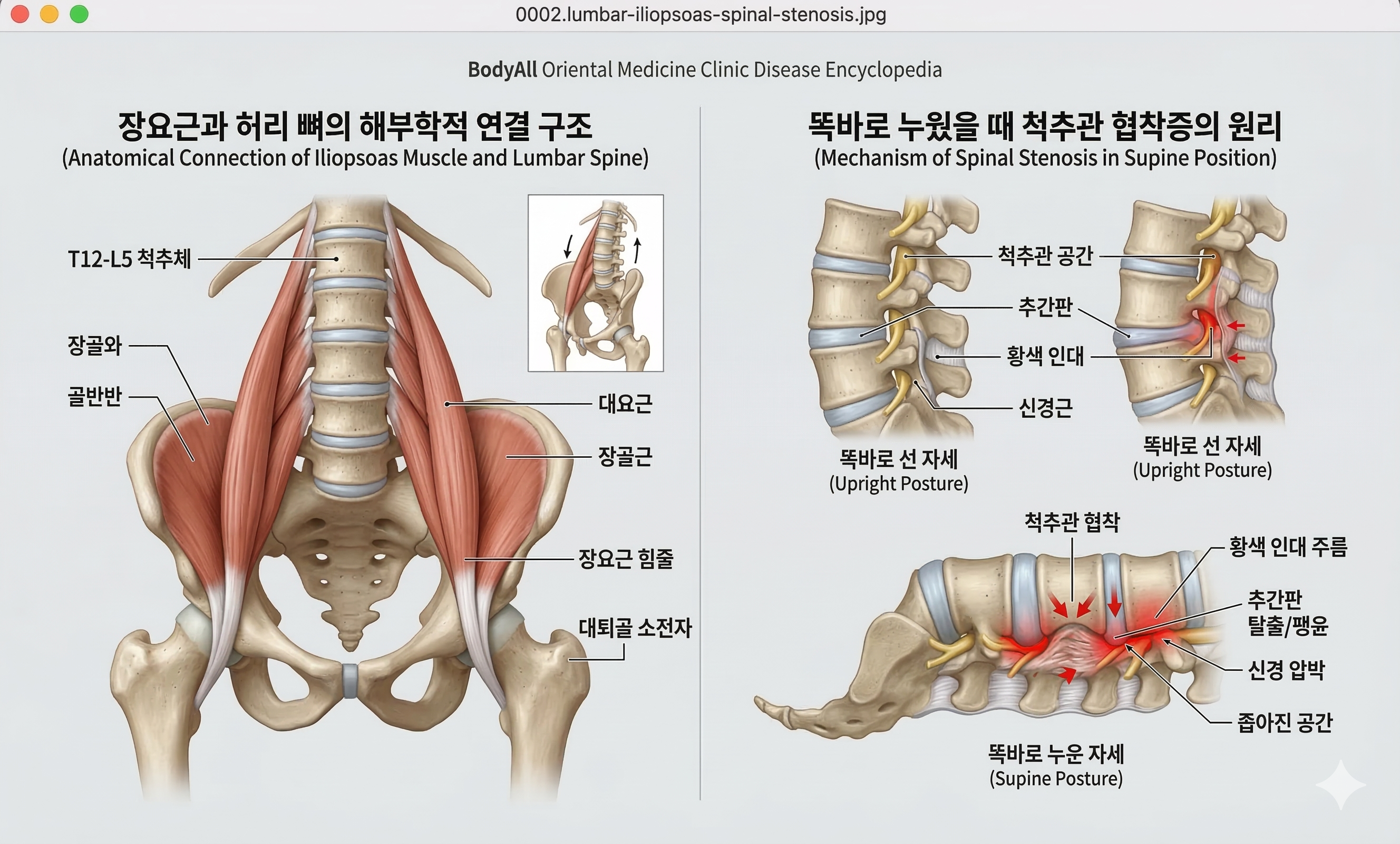 Mechanism of spinal stenosis and iliopsoas shortening
