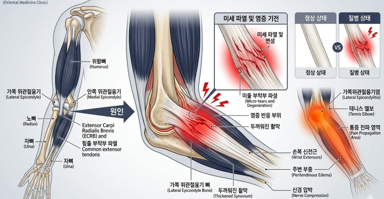 Tennis elbow mechanism and anatomical diagram of tendon damage