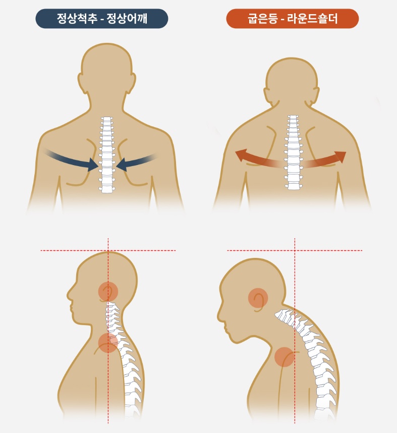 Anatomical correlation between rounded back, rounded shoulder, and rotator cuff pain